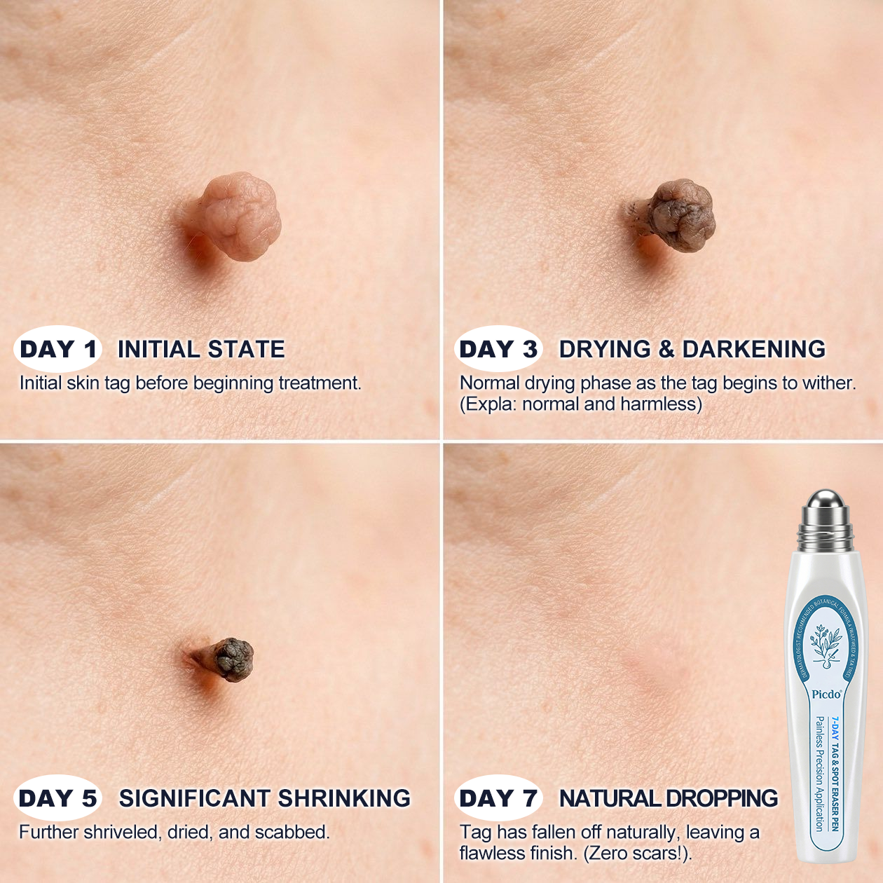 Official Picdo Store ✅ Trilumia® 7-Day All Skin Imperfection Remover Pen (Gentle Painless Formula, Leaves Zero Scars)🍓