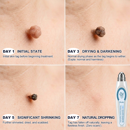 Official Picdo Store ✅ Trilumia® 7-Day All Skin Imperfection Remover Pen (Gentle Painless Formula, Leaves Zero Scars)🍓